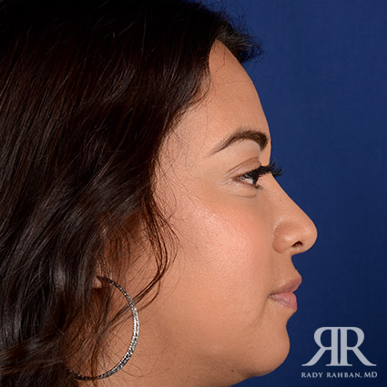 Corrective / Revision Rhinoplasty