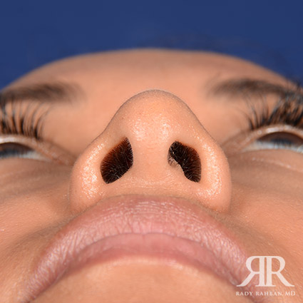 Corrective / Revision Rhinoplasty