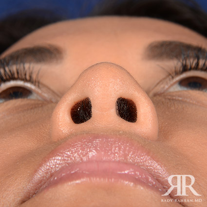 Corrective / Revision Rhinoplasty