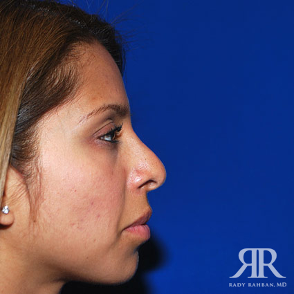 Corrective / Revision Rhinoplasty