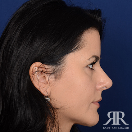 Corrective / Revision Rhinoplasty