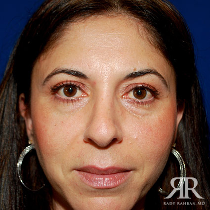 Corrective / Revision Rhinoplasty