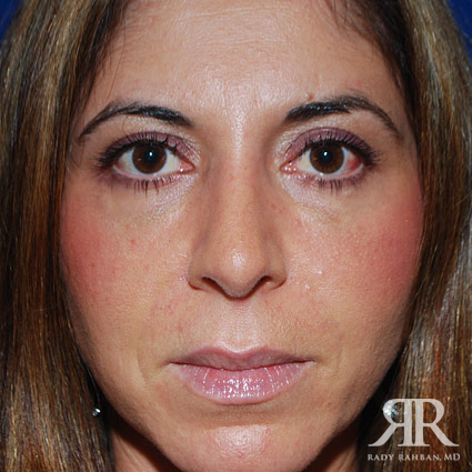 Corrective / Revision Rhinoplasty