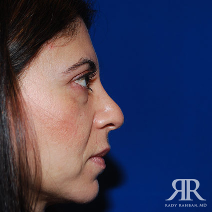 Corrective / Revision Rhinoplasty