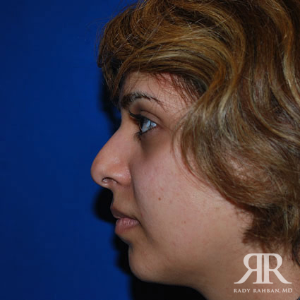 Corrective / Revision Rhinoplasty