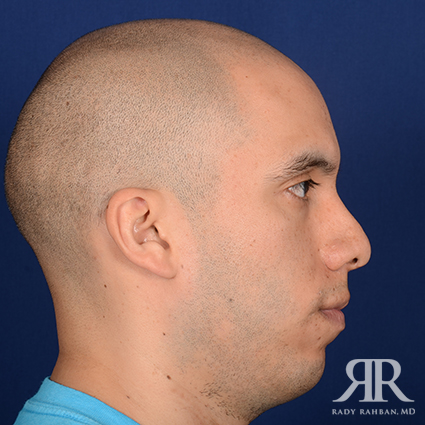 Corrective / Revision Rhinoplasty