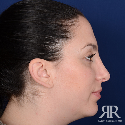 Corrective / Revision Rhinoplasty