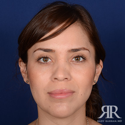 Corrective / Revision Rhinoplasty