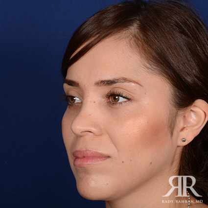 Corrective / Revision Rhinoplasty