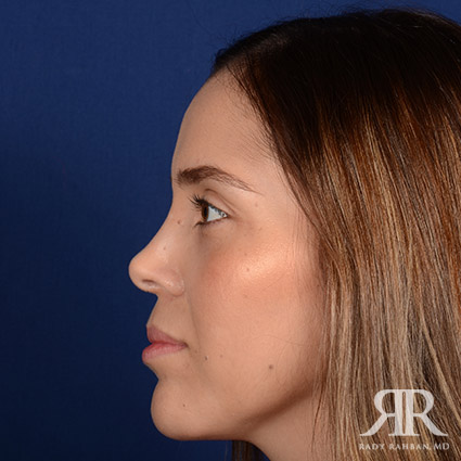 Corrective / Revision Rhinoplasty