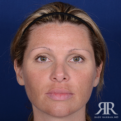 Corrective / Revision Rhinoplasty