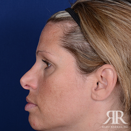 Corrective / Revision Rhinoplasty