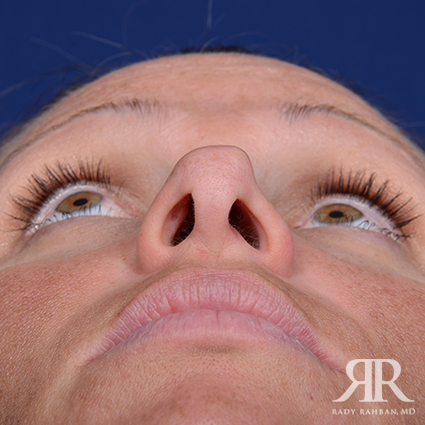 Corrective / Revision Rhinoplasty