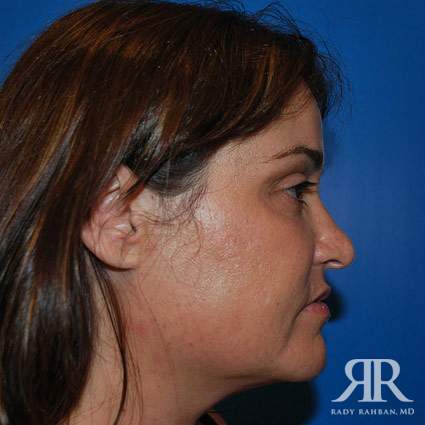 Corrective / Revision Rhinoplasty