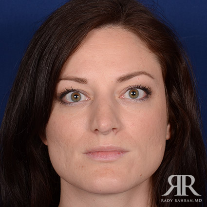 Corrective / Revision Rhinoplasty