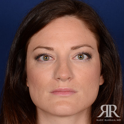 Corrective / Revision Rhinoplasty