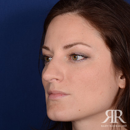 Corrective / Revision Rhinoplasty