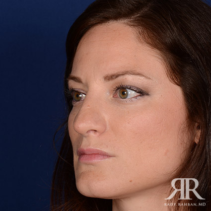 Corrective / Revision Rhinoplasty