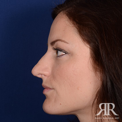 Corrective / Revision Rhinoplasty