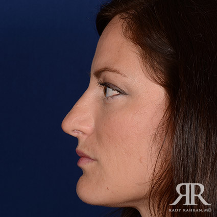 Corrective / Revision Rhinoplasty