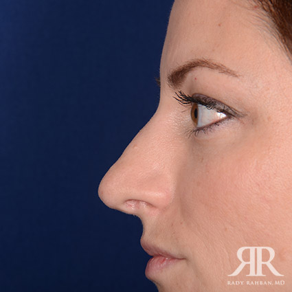 Corrective / Revision Rhinoplasty