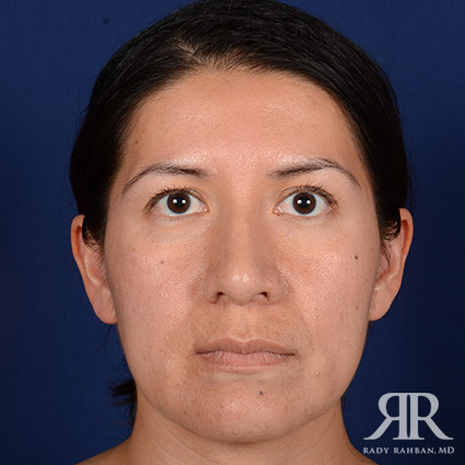 Corrective / Revision Rhinoplasty