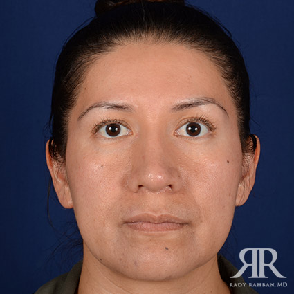 Corrective / Revision Rhinoplasty