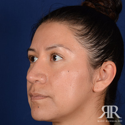 Corrective / Revision Rhinoplasty