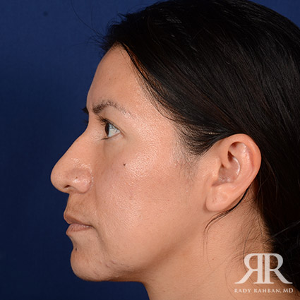 Corrective / Revision Rhinoplasty