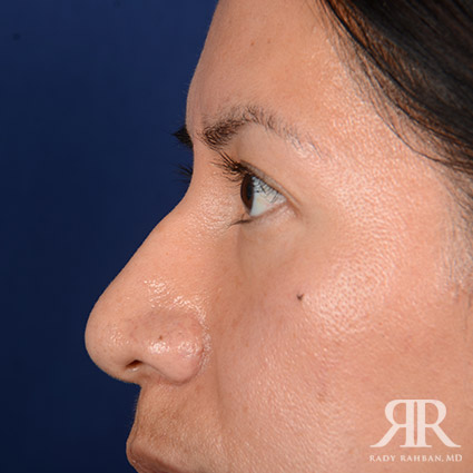 Corrective / Revision Rhinoplasty