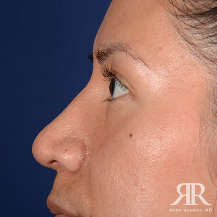 Corrective / Revision Rhinoplasty