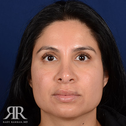 Corrective / Revision Rhinoplasty