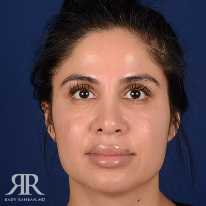 Corrective / Revision Rhinoplasty