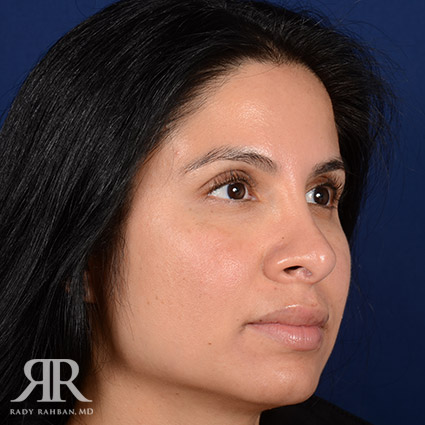 Corrective / Revision Rhinoplasty