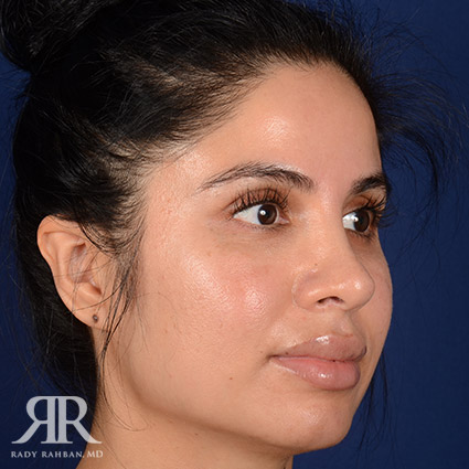 Corrective / Revision Rhinoplasty