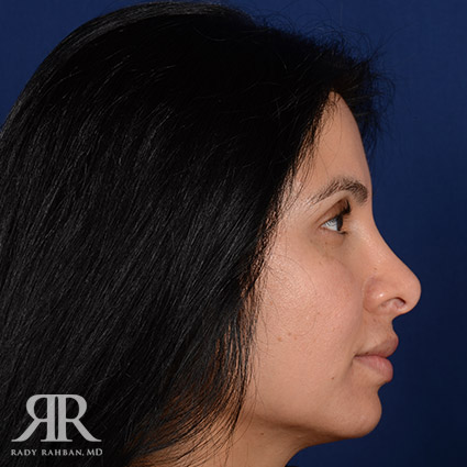 Corrective / Revision Rhinoplasty