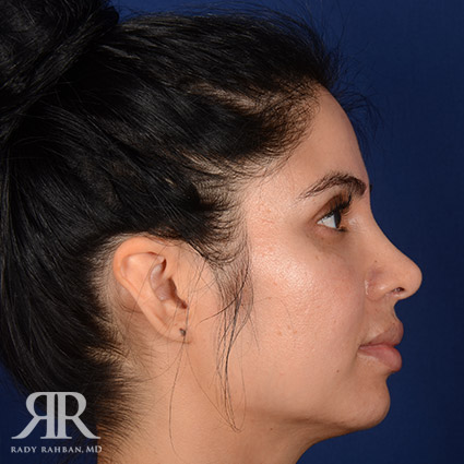 Corrective / Revision Rhinoplasty