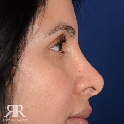 Corrective / Revision Rhinoplasty