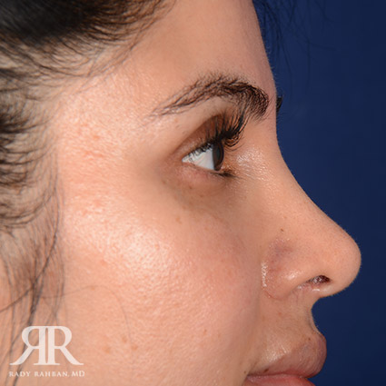 Corrective / Revision Rhinoplasty