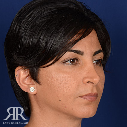 Corrective / Revision Rhinoplasty