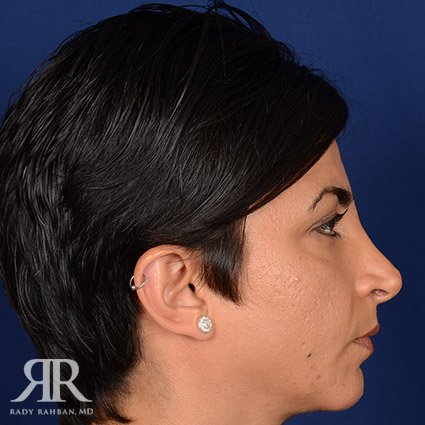 Corrective / Revision Rhinoplasty