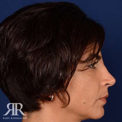 Corrective / Revision Rhinoplasty