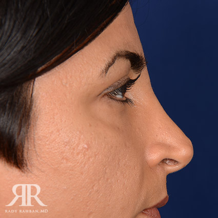 Corrective / Revision Rhinoplasty