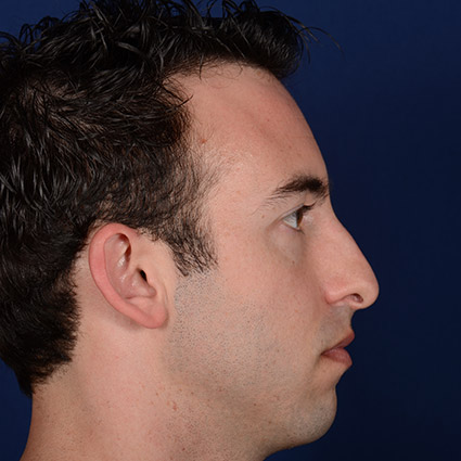 Rhinoplasty w/ Chin Implant