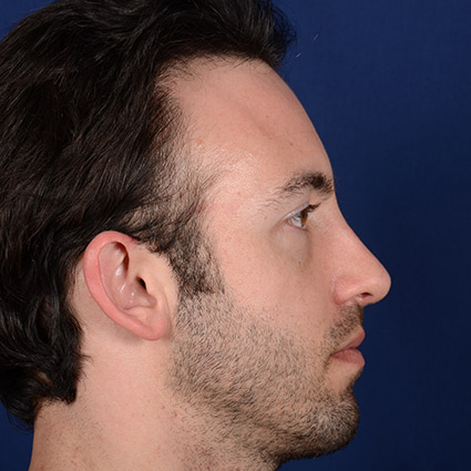 Rhinoplasty w/ Chin Implant