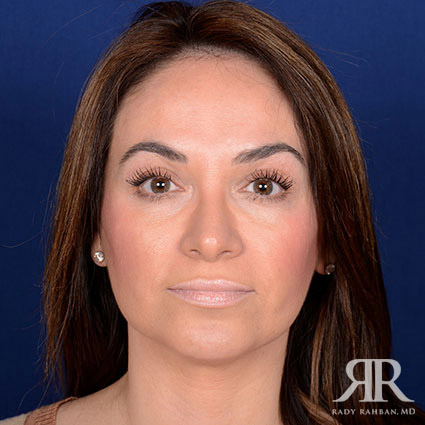 Woman that received rhinoplasty and a chin implant