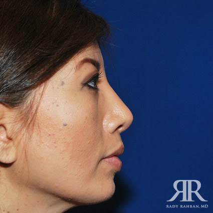 Rhinoplasty w/ Chin Implant
