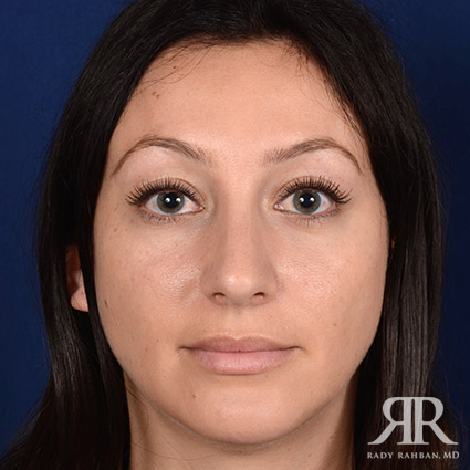 Rhinoplasty w/ Chin Implant