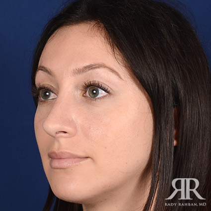 Rhinoplasty w/ Chin Implant