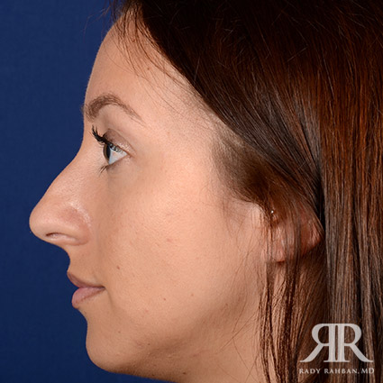 Rhinoplasty w/ Chin Implant